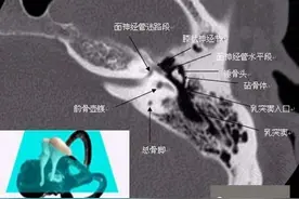 中耳乳突解剖及常见疾病影像诊断图片