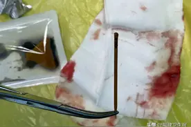 吞下牙签3天后，福州小伙面临切除小肠......图片