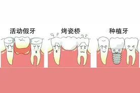 口腔科专家带您认识人类的“第三副牙齿”——种植牙图片
