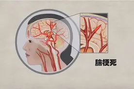 脑梗死患者需要注意什么？不吃什么？图片