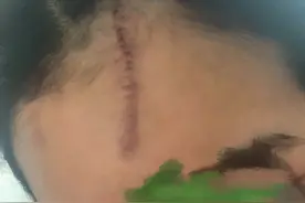 90后妹子美团打车遇事故 额头留下8厘米伤口图片