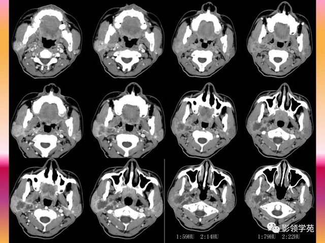 腮腺角化型鳞癌
