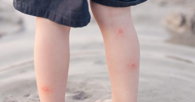 小孩脚扭伤了怎么办