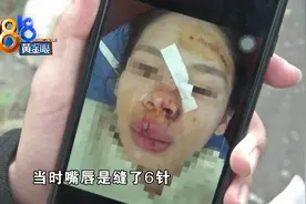 村道上堆满石子，姑娘骑车磕肿脸，嘴唇还缝了六针图片
