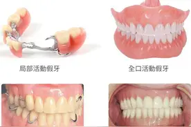 【老年健康宣传周】活动假牙佩戴指导，看这篇就够了图片