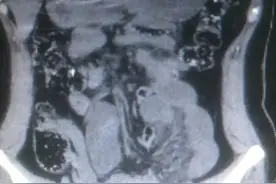 右下腹剧烈疼痛，以为是尿路结石，直到剖腹探查，才找到真正病因图片