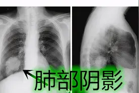肺部检查出现阴影、结节，治还是不治？到底该怎么办？医生告诉你图片