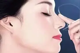 鼻整形会影响鼻功能吗？这篇文章给你一个明确的答案图片
