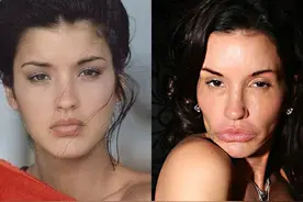 慎入！整容失败到底有多恐怖？7个灾难级案例，贵族都难以幸免图片