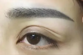 眉部网格化分区与脂肪移植图片