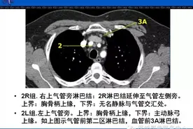 纵隔淋巴结增大、心包囊肿影像诊断图片