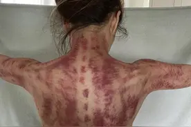 天后郑秀文晒刮痧照，背部手臂呈深红色，身体状况令人担心图片