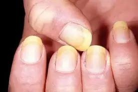 指甲出现这几种变化，多半是身体在“求救”图片