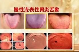 出现这种舌象，可能是胃癌前病变！两杯茶一碗粥，养出好脾胃图片