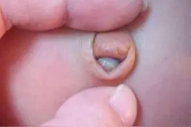 宝宝肚脐中央有粉红色的小肉球是什么东东？图片
