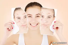 粉刺、痤疮应该怎么治？不同的痘痘，用药方案有所不同图片