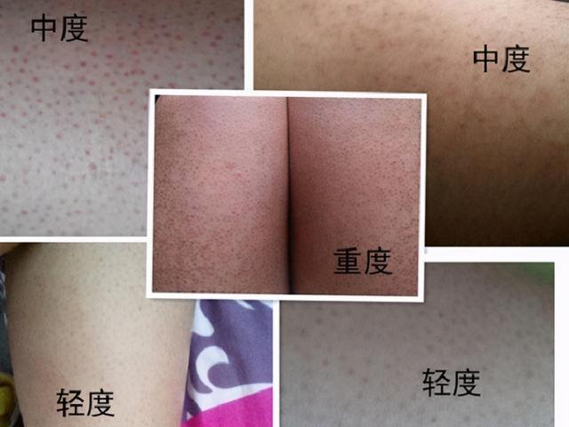 胳膊上有一小块干燥起皮类似鸡皮疙瘩
