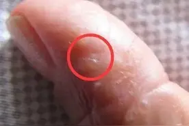 手上长透明小水泡，还反复发作？想要摆脱，有3件事能少做就少做图片