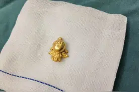 现实版“吞金兽”！一不留神，9个月大婴儿吞下金吊坠图片