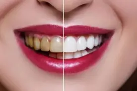 什么原因可能导致牙齿染色变黄呢？图片