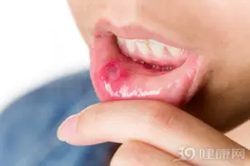 口腔溃疡总不好？嘴巴都烂了！几种药可以治好，实用还不贵图片