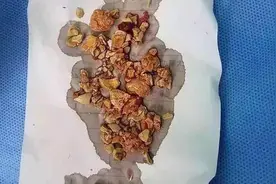 5个月宝宝肾结石，医生：都是辅食惹的祸，很多家庭还在这么喂图片