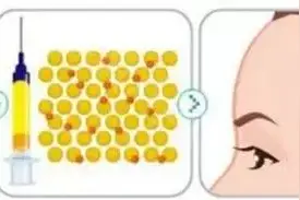 丰额头常用的治疗方案有哪些？图片