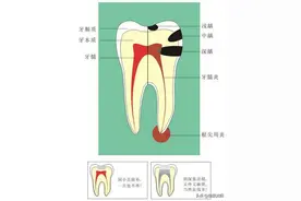 健康科普堂 | 带您了解龋病的相关知识图片