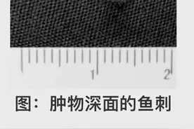 女子舌头肿胀，吞咽困难！去医院一查：这一食物已在舌头里“待了小半年”，餐桌上很常见！图片