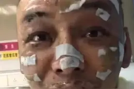 睡前没熄灭香薰蜡烛，说唱歌手在家深度烧伤图片