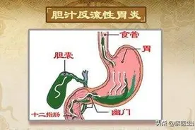 胃镜发现胆汁反流，这是怎么回事？需要治疗吗？如何治疗？图片