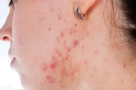 青春痘到底有多烦人？图片