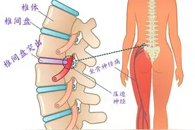 为何出现坐骨神经痛，反复治不好？该如何应对？请看此文图片