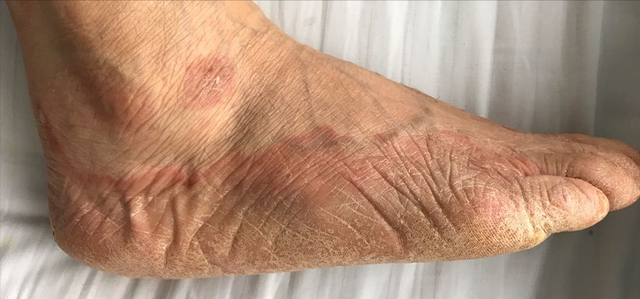 国医大师谈角化型手足癣验方