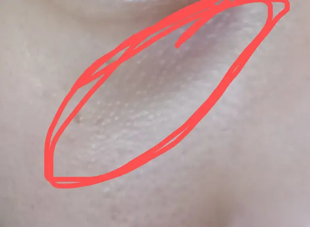 毛周角化症咋治疗