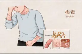 令人“闻风丧胆”的梅毒，患上它之后还能活多久？图片