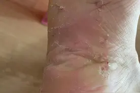 如图脚气已三年，求网友支招图片