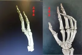手指发生骨折，只能通过手术治疗吗？| 健康问答 120 期图片