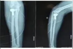 肘关节三联征治疗方案的深入讨论图片