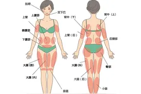 吸脂是不是就是减肥？吸完就一劳永逸了吗？图片