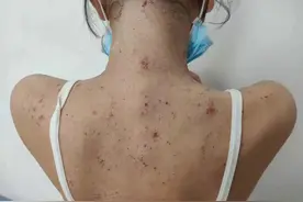 痒痒痒！每天都抠到流血，12岁女孩患上“不死的癌症”！图片