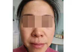 51岁想做拉皮手术？不妨参考一下我的经历图片