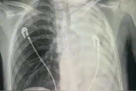 12岁男孩连咳2分钟，咳出「管形凝血块」，医生却松了一口气……图片