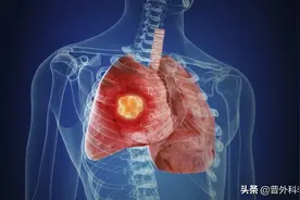 79岁肺鳞癌，内蒙古的专家说无药可治，去上海还有用吗？图片