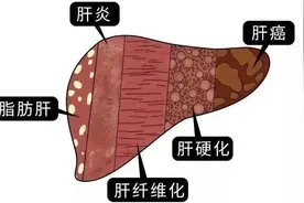 猪为什么不得脂肪肝，不得糖尿病？图片