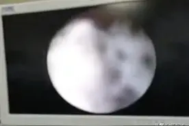2岁女童下体间断性出血，还有异味！母亲怀疑性早熟，原因意外图片