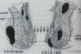 健康科普堂 | 秋冬季警惕肛旁的小包包图片