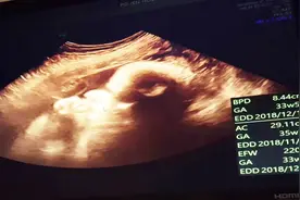 实拍老婆怀孕第33周B超产检全过程，宝宝的心跳都能看的很清楚！视频封面