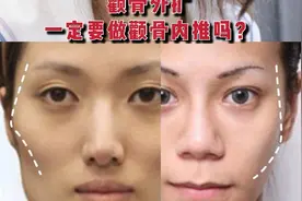 颧骨外扩，一定要做颧骨内推吗？图片