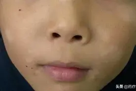 儿科医生：孩子脸上有白斑，先别急着“打虫”，补点维生素就搞定图片